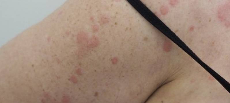 Orticaria linfonodi Trieste