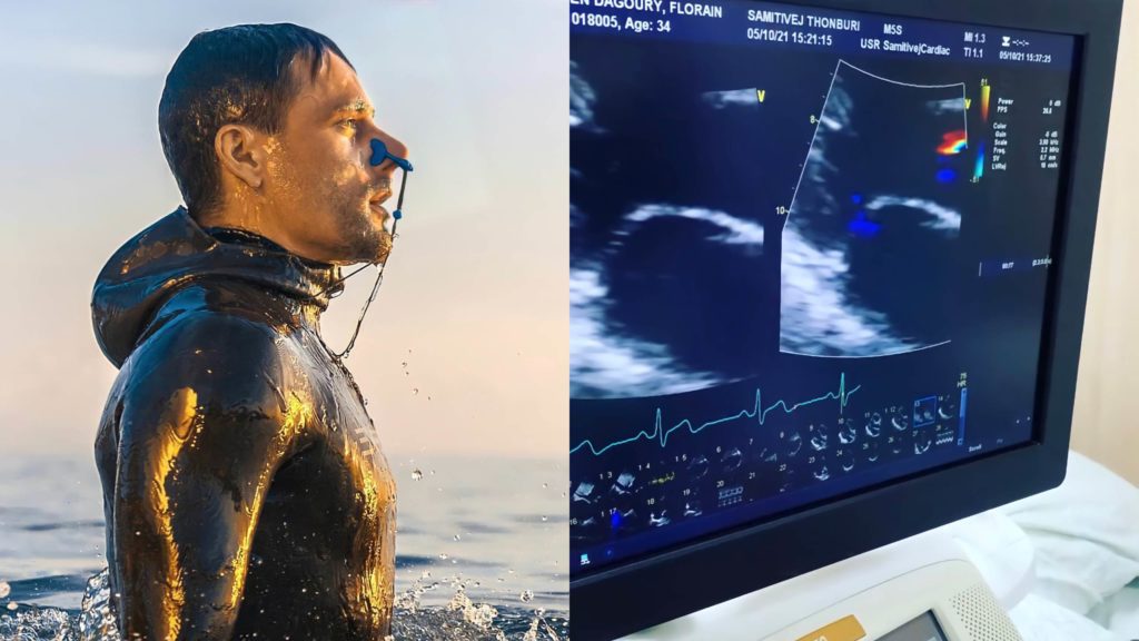 Florian Dagoury the Worlds Top Static Freediver Is Diagnosed with Myocarditis After Taking Pfizer Vax