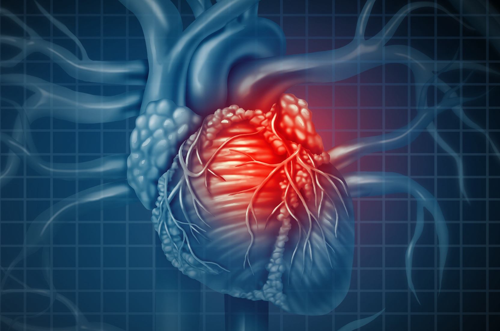 Stenosi aortica: l’ultima giustificazione dell’infarto