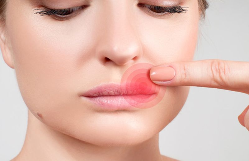herpes simplex, cause e rimedi naturali