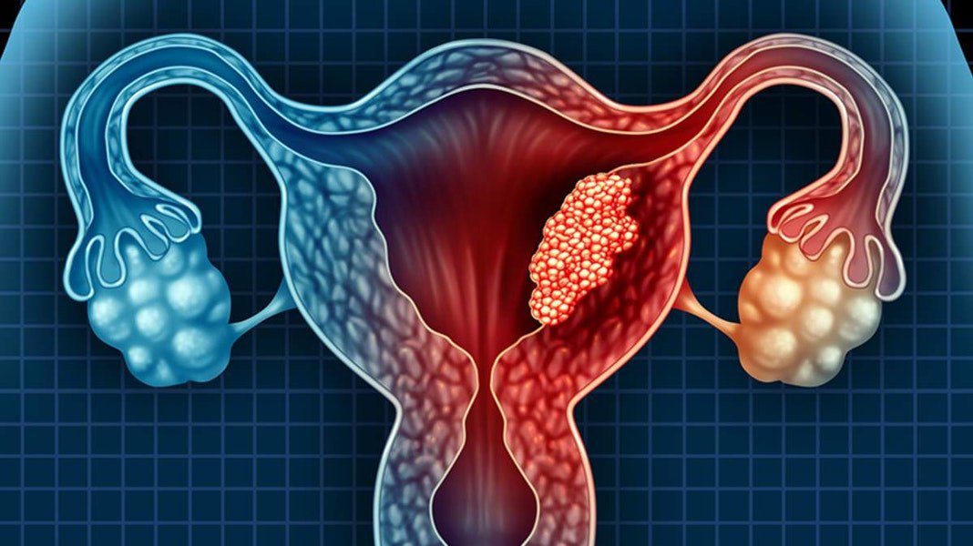 Il genoma della proteina spike del Sars-Cov-2 contiene una sequenza genica precancerosa brevettata da Moderna