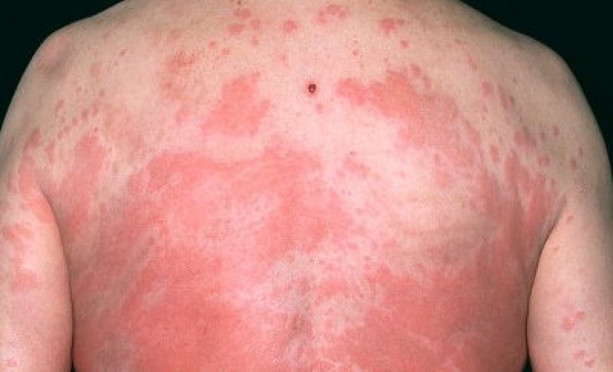 Reazioni cutanee anche gravi dopo la vaccinazione anti-covid