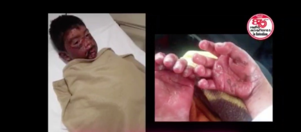 Bambino di 8 anni colpito da gravissima reazione dopo il vaccino Pfizer