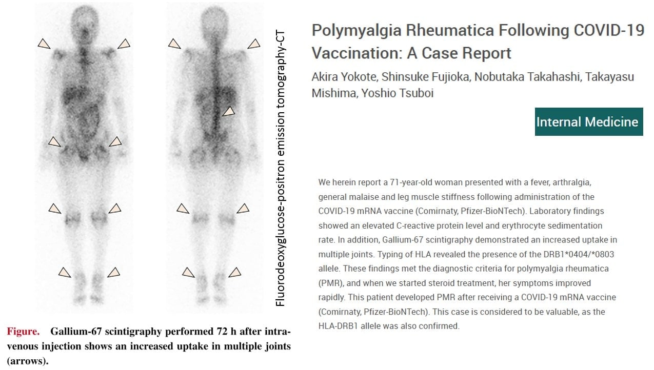 Polimialgia reumatica dopo la vaccinazione COVID-19 un caso clinico