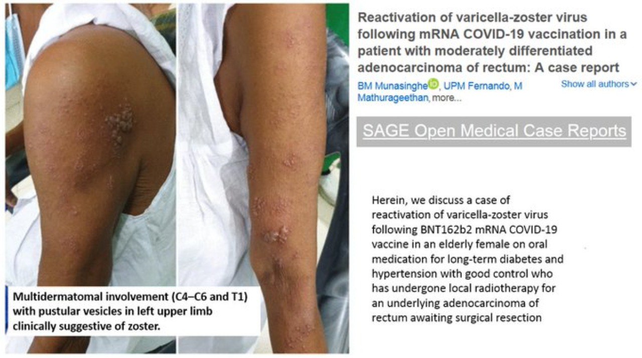 Riattivazione del virus varicella-zoster a seguito della vaccinazione mRNA COVID-19 un caso clinico