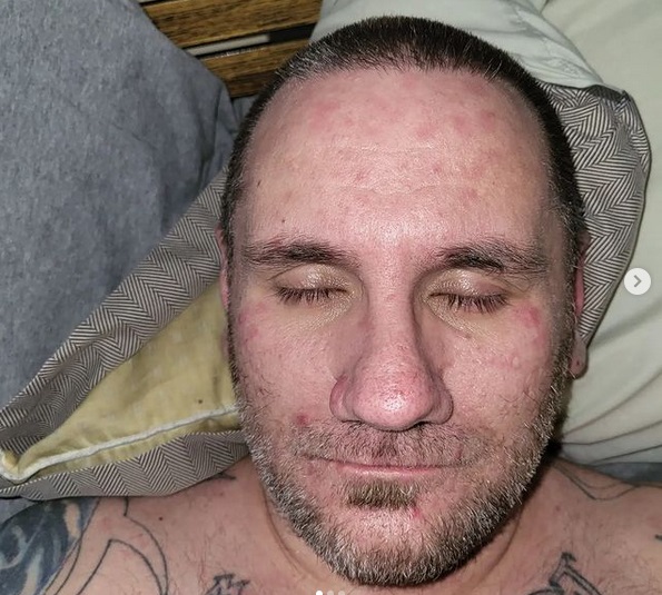 Jeff Jackson – Lichenoid Dermatitis and extreme skin reactions following Moderna vaccine (1)