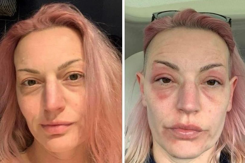 Woman claims reaction to the Pfizer booster saw her 'age 20 years in three days' Michelle Flower