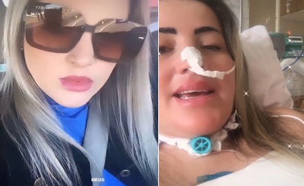 Modella brasiliana colpita da Sindrome di Guillain Barré 15 giorni dopo il vaccino