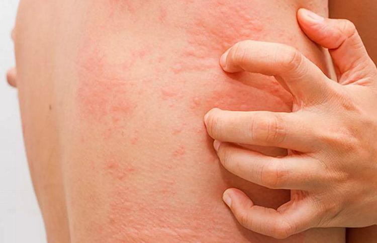 Herpes zoster, vaiolo delle scimmie e HIV: c’è un legame con il vaccino anti COVID-19?