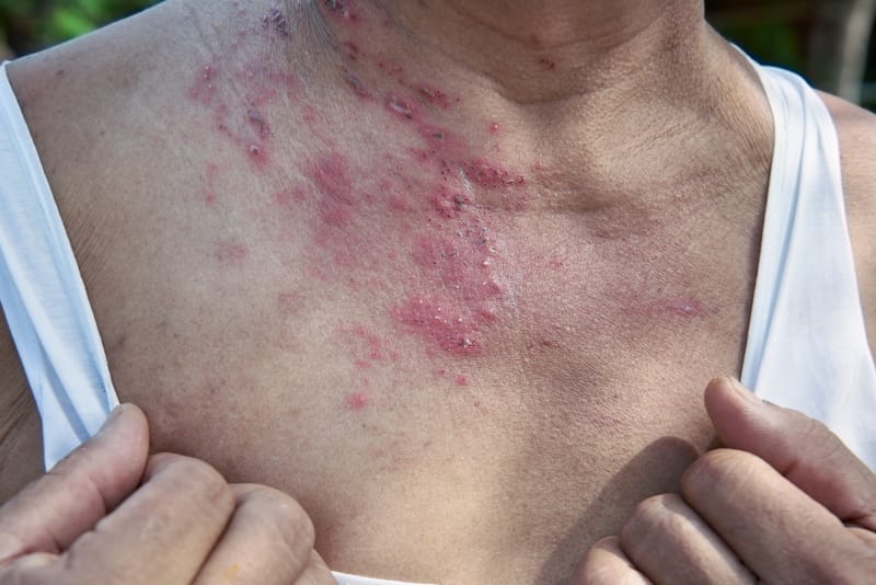 Rilevata la proteina Spike nelle lesioni cutanee da Herpes Zoster
